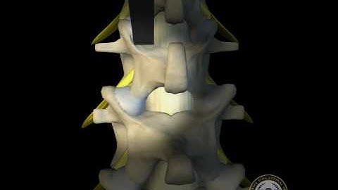 MIS TLIF Procedure