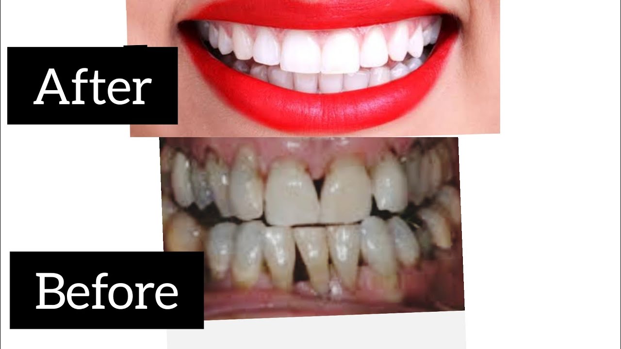 how-to-permanently-whiten-teeth-in-2-minutes-remove-plaque-receding