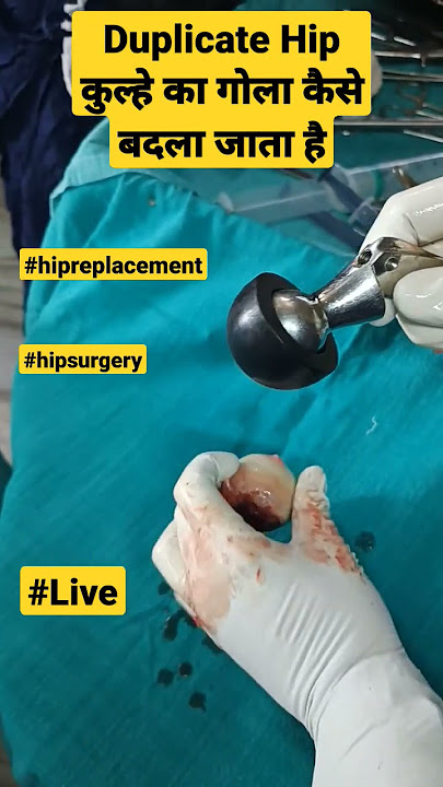 Duplicate Hip कुल्हे का गोला कैसे बदला जाता है | #hipreplacement #avascularnecrosis #hippain #mbbs