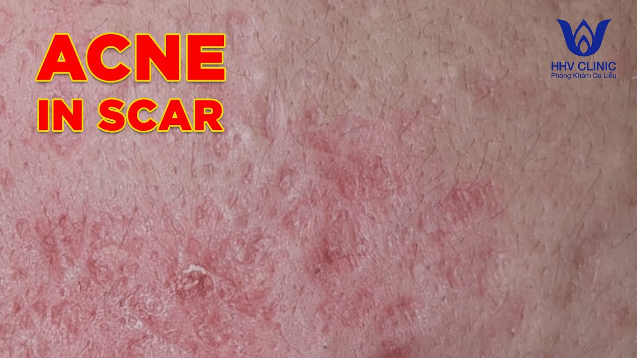 HHV Clinic | dothuhien | hienvanspa - Acne in scar - Huu Tri - part 2