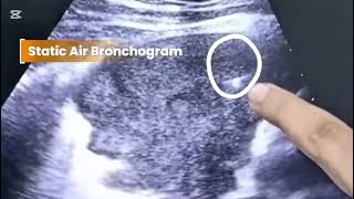 Static air bronchogram -- Lung collapse