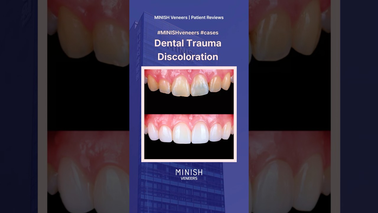 Dental Trauma Discoloration | Shade Fix with Veneers