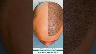 Hair Implantation Cost | Radiance Advanced hair Transplantation center