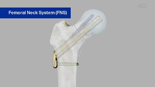 Femur, Neck-Fracture 31B-Stabilization Using the Femoral Neck System FNS