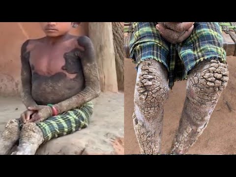Vídeo: O Menino Ficou Petrificado Devido A Uma Doença Rara - Visão Alternativa