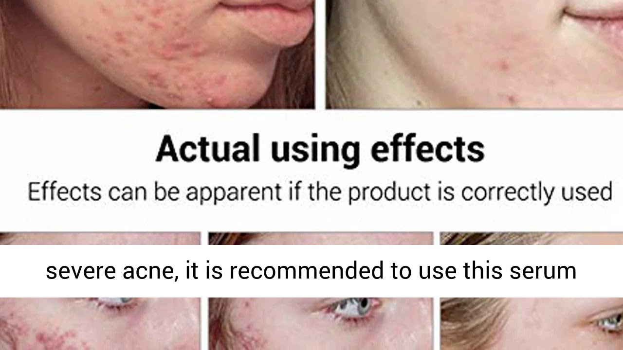 Acne Treatment Serum - BREYLEE Tea Tree Clear Skin Serum for Clearing