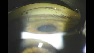 58  Video 2 8 Plateau Iris Syndrome by Wallace Alward, MD