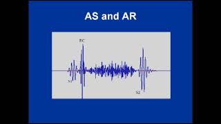 Aortic Stenosis and Aortic Regurgitation