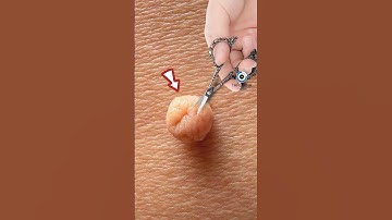 VÌ SAO KHÔNG NÊN CẮT MỤN THỊT | 😨(Bạn Biết Không) #thaukinhtrithuc #fact #amazingfact