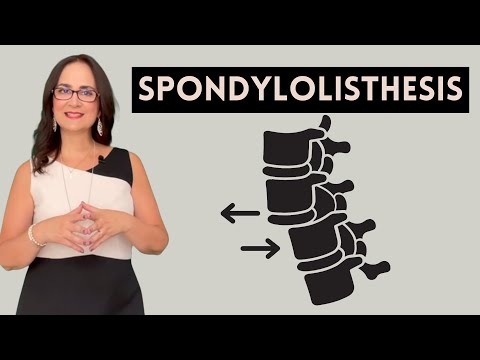 What is SPONDYLOLISTHESIS and how is it treated? Dr Furlan answers 5 questions in this video