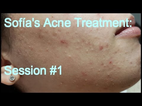 Sofia&#;s Acne Treatment: Session #