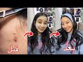 اقوي ماسك للحبوب والتصبغات واثار الحبوب الحبوب هتختفي في يوم واحد فقط تجهيزات العيد 