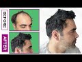 Hair transplant transformation watch this journey to astonishing results  care well medical centre