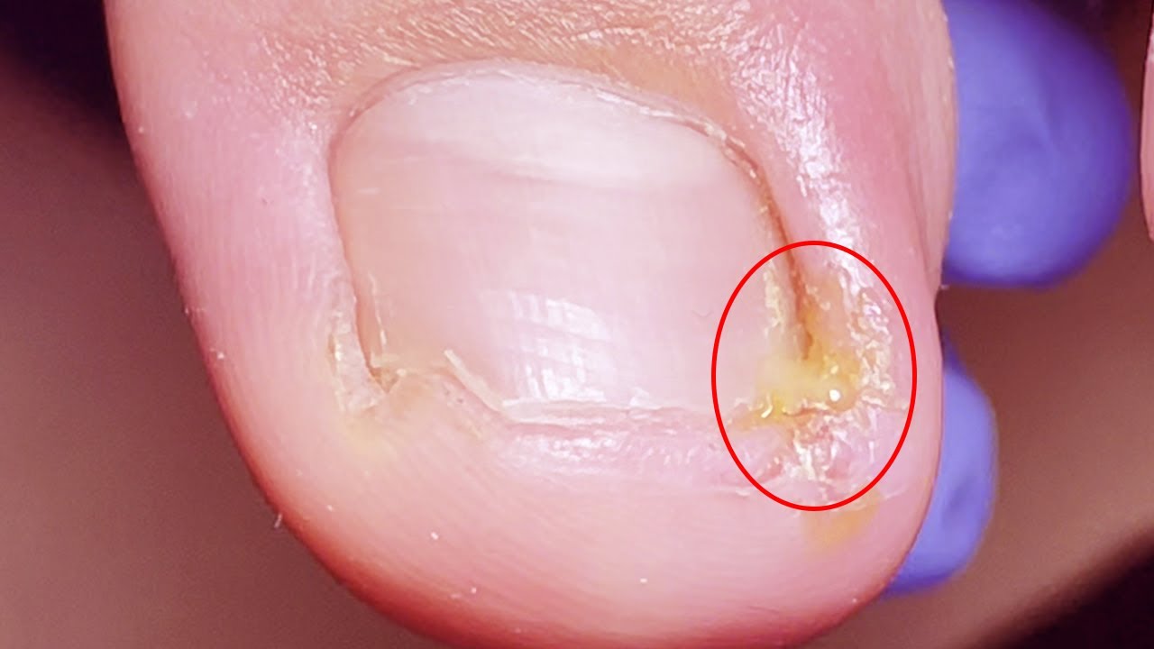 Ingrown toenails seriously affect normal life, swollen toes YouTube