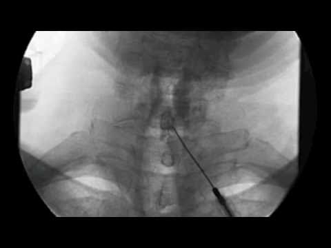 Epidural steroid injection video