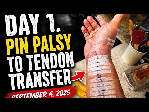 Day 1. Pin palsy to tendon transfer ￼September 4, 2025