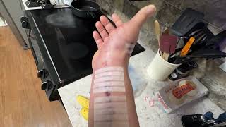 Day 1.  Pin palsy to tendon transfer  ￼September 4, 2025