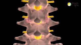 Lumbar facet joint injection under X-ray Guidance