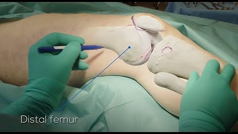 Distal femoral fracture fixation with lateral locking plate preview