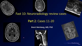 Fast 10: Neuroradiology high speed case review Part 2 - Cases 11-20