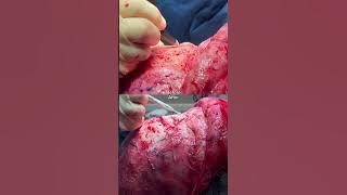 Watch the full facial feminization surgery out now on Snapchat @RealDrSeattle