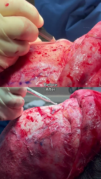 Watch the full facial feminization surgery out now on Snapchat @RealDrSeattle
