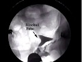 getting pregnant after laparoscopy to unblock tubes