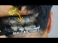 Really Big Dandruff Flakes On Back Of Neck!!! Dandruff Removal Satisfying #265