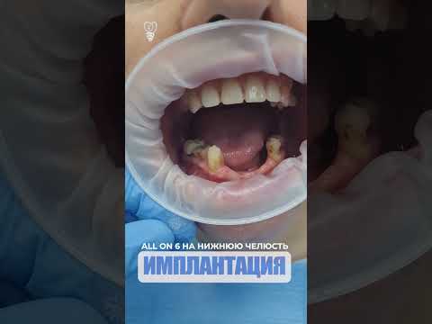 All On 6 на нижнюю челюсть- All On 6 On The Lower Jaw- Implantation-