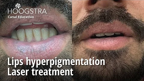 Lips hyperpigmentation - Laser treatment - 22226