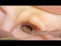 ASMR : 耳掃除の快感!リアル音でゾクゾクが止まらない👂✨