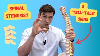 The 5 "Tell Tale" Signs of Spinal Stenosis