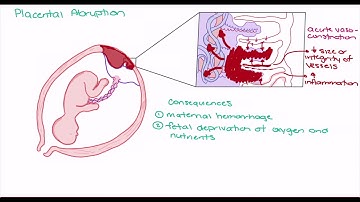 Placental Abruption