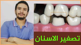 الكميه الصحيحه التى يتم ازالتها من السن اثناء برد الاسنان لعمل التركيبات الثابته