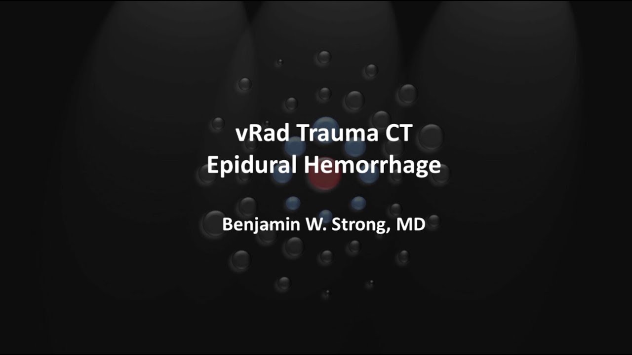 Epidural Hemorrhage | 10-minute Radiology Case Reviews