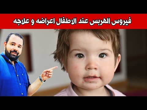 فيروس الهربس عند الاطفال اعراضه و علاجه | اعراض الهربس عند الاطفال | علاج الهربس عند الاطفال الرضع