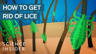 Why Lice Are So Hard To Kill Resimi