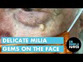 Delicate Milia Gems on the Face