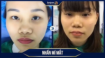 Nhấn mí Multi-Point: Tạo mắt 2 mí tự nhiên không phẫu thuật