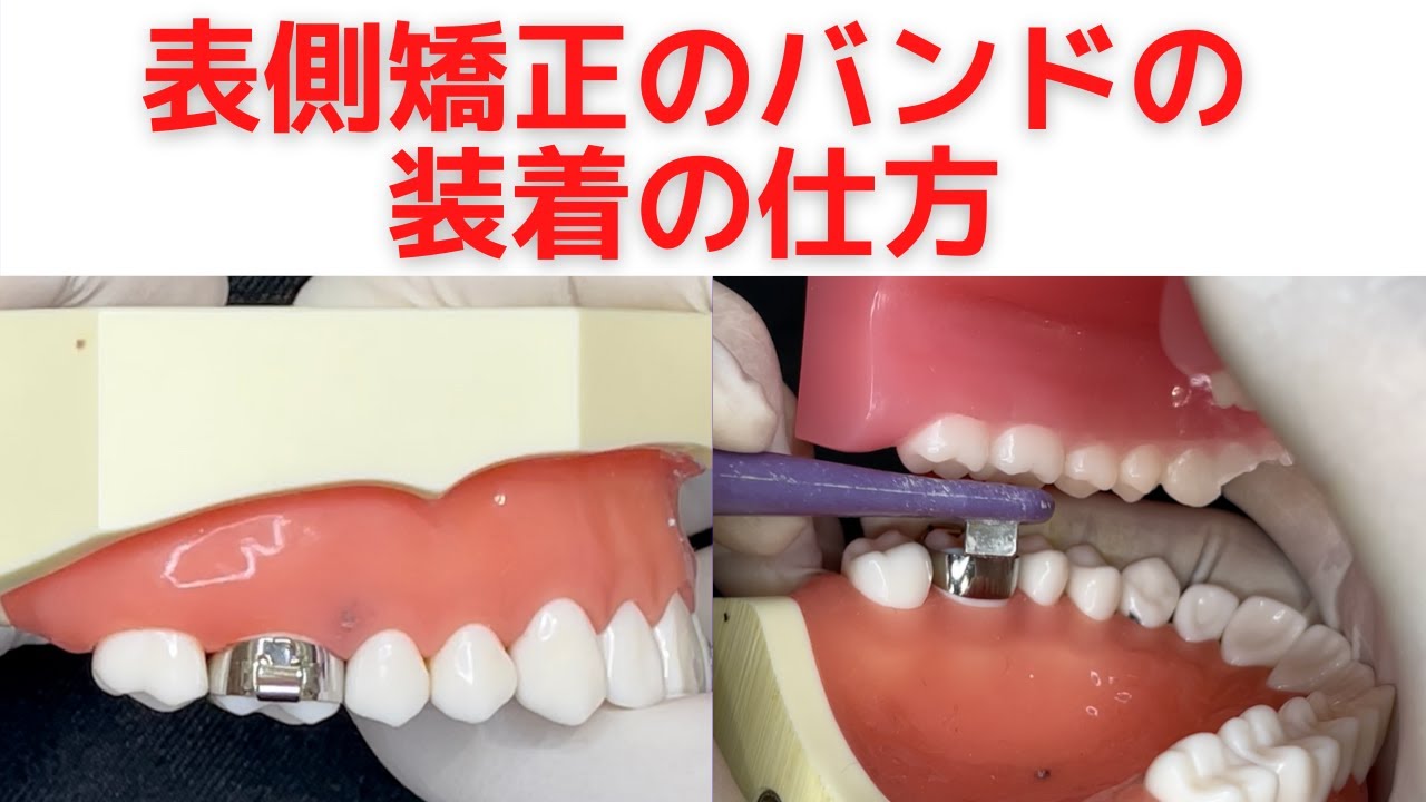 表側矯正のバンド装着の様子 模型で矯正歯科医が解説 Youtube 表側矯正のバンド装着の様子 模型で矯正歯科医が解説 Youtube