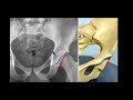 MRI Hip Made Easy