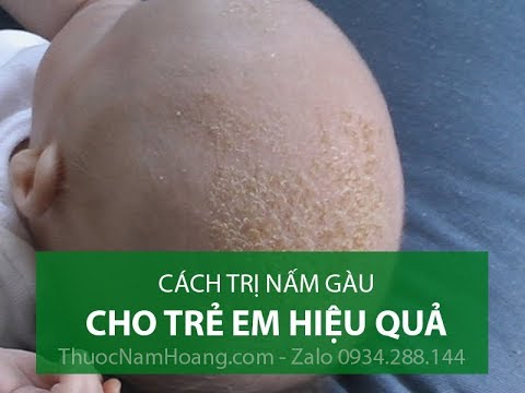 Tư vấn - Cách trị gàu cho EM BÉ và trẻ em Đơn giản, Hiệu quả nhất [2019]