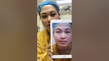 Chiêm Ngưỡng Kết Quả Cắt Mí Mắt Mani Mini Deep 5D Tại Dr.Hải Lê