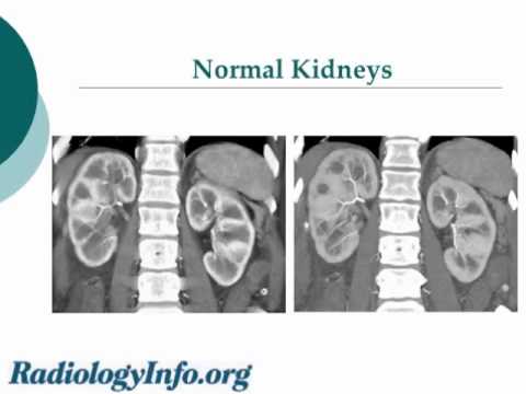 Your Radiologist Explains: Computed Tomography (CT) of the Kidneys