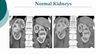 Your Radiologist Explains: Computed Tomography (CT) of the Kidneys