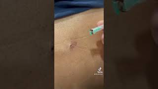 Subcision to Cysts on Back treatment?.   calvinskin blackheadremoval oilyskin subcision cysts