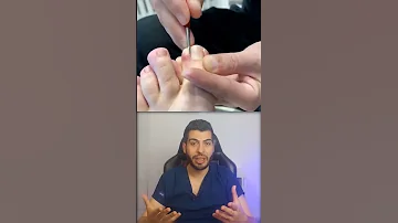 الظفر الكماشة ظفر الظفر الاظافر وراثي الوراثة امراض صحة د مصعب حسوا ثقف نفسك طبيا 