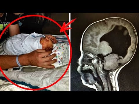 Vídeo: Un Niño Sin Cerebro Nació Hace Siete Años. Qué Le Pasó Y Cómo Vive Hoy - Vista Alternativa