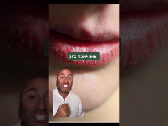 сухие губы что делать, причины,
