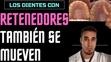 ¿Los retenedores amarillean los dientes?